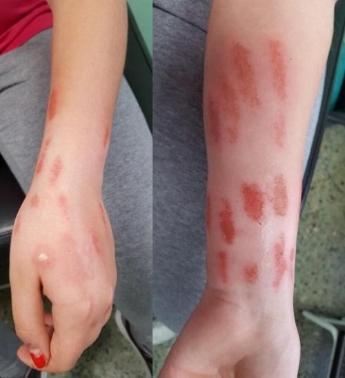 Figura 1. Lesiones por rascado